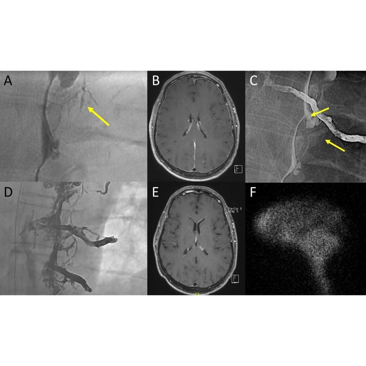 JNIS (@jnis_bmj) on Twitter photo Brinjikji et al report their experience with 100 patients with CSF-venous fisulas. Impressive 95% treatment response, significant improvement in imaging outcomes, and low complications. bit.ly/4eLLjLL <a href="/JCGneuro/">Jeremy Cutsforth-Gregory MD</a> #fistula #embolization Brinjikji et al report their experience with 100 patients with CSF-venous fisulas. Impressive 95% treatment response, significant improvement in imaging outcomes, and low complications. bit.ly/4eLLjLL <a href="/JCGneuro/">Jeremy Cutsforth-Gregory MD</a> #fistula #embolization