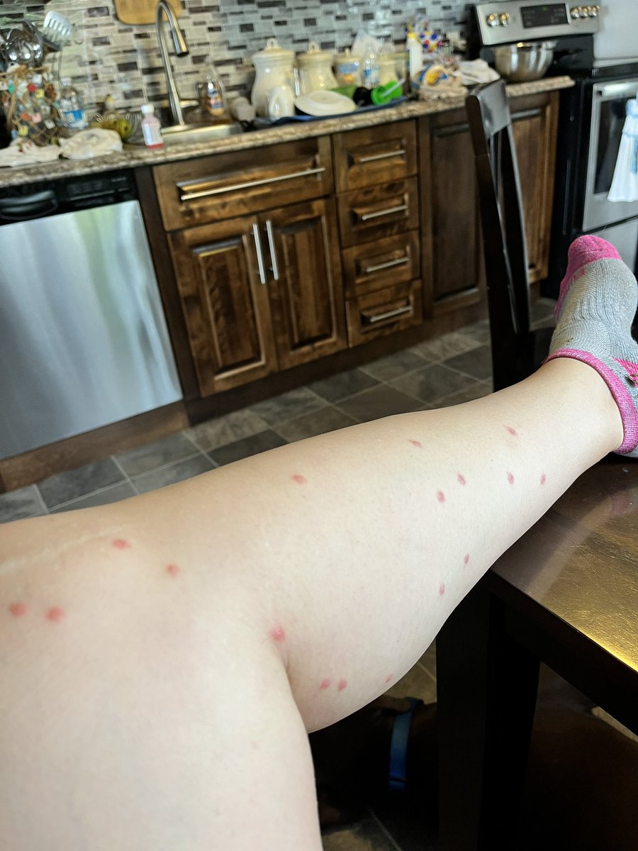 KMRD83's tweet photo. Took kids swimming at Sandy Pond in #TerraNova. Ended up with swimmers itch…us and our kids covered in a painful, itchy rash. No signage notifying  parasite is present. Pharmacist advised locals know not to swim there. @ParksCanada @GovNL @Cliffordsmall12  @GovCanHealth https://t.co/by2r7f2Bze
