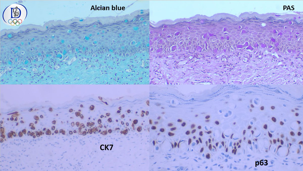 Int Soc Dermpath (@intsocdermpath) on Twitter photo #ISDP #Olympics
Spot diagnosis
Case 4 - <a href="/JCandidoXavier/">Jose Candido</a>
EXTRAMAMMARY PAGET DISEASE
Intraepithelial proliferation of cells with vesicular nuclei and basophilic/amphophilic cytoplasm.
Cells distributed in a solitary fashion or in nest/gland-like structures
#derm #path #med #ISDP #Olympics
Spot diagnosis
Case 4 - <a href="/JCandidoXavier/">Jose Candido</a>
EXTRAMAMMARY PAGET DISEASE
Intraepithelial proliferation of cells with vesicular nuclei and basophilic/amphophilic cytoplasm.
Cells distributed in a solitary fashion or in nest/gland-like structures
#derm #path #med