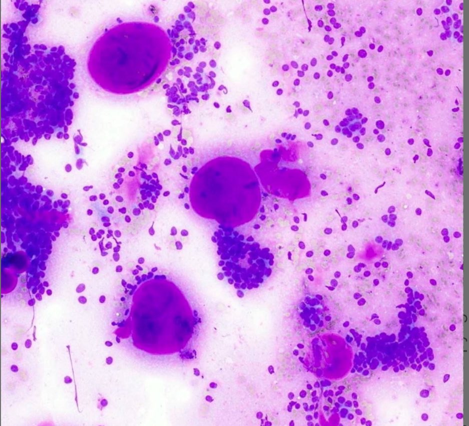 philly_path's tweet photo. Hi #PathX! A 50-year-old female presents with a 2.5 cm peribronchial mass. Below are the FNA smears and core biopsy. What is your diagnosis? #Pulmpath #Pathology https://t.co/jbML96Bigq https://t.co/Em93s2CSGX