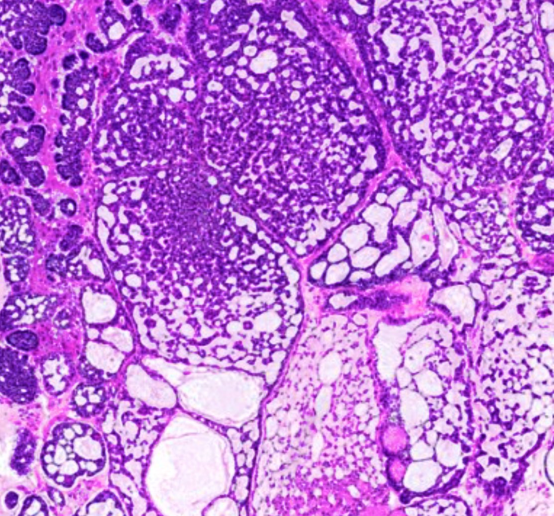 philly_path's tweet photo. Hi #PathX! A 50-year-old female presents with a 2.5 cm peribronchial mass. Below are the FNA smears and core biopsy. What is your diagnosis? #Pulmpath #Pathology https://t.co/jbML96Bigq https://t.co/Em93s2CSGX