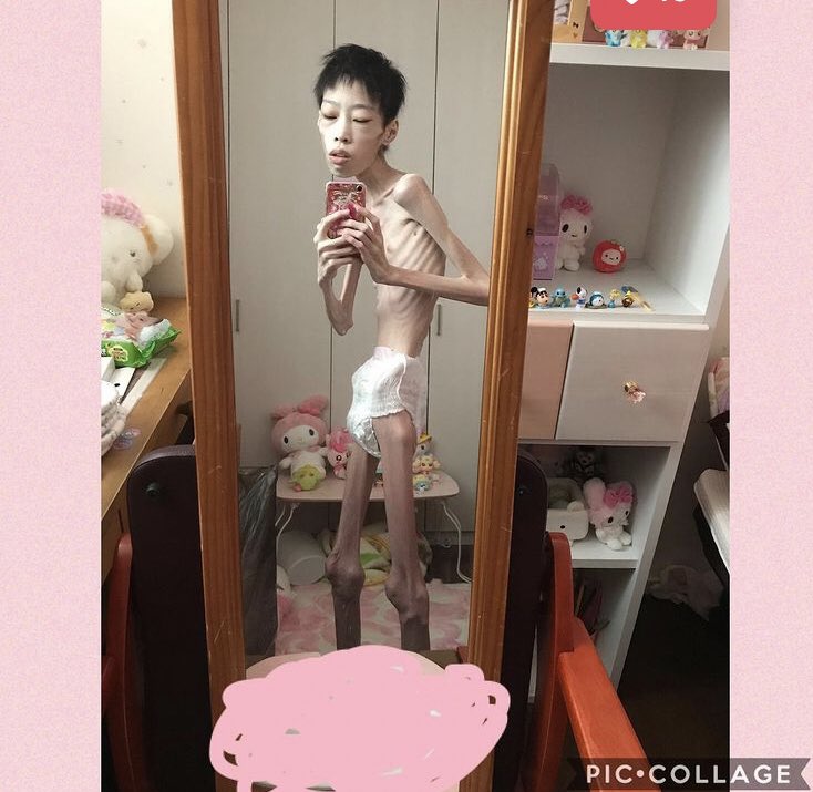 240628j's tweet photo. #拒食症 #痩せ姫 #拒食障害

2020.12

#体系記録 #足の細さ #骸骨　#裸
#プリキュア大好き　#おむつ https://t.co/gqYhOqPjcK