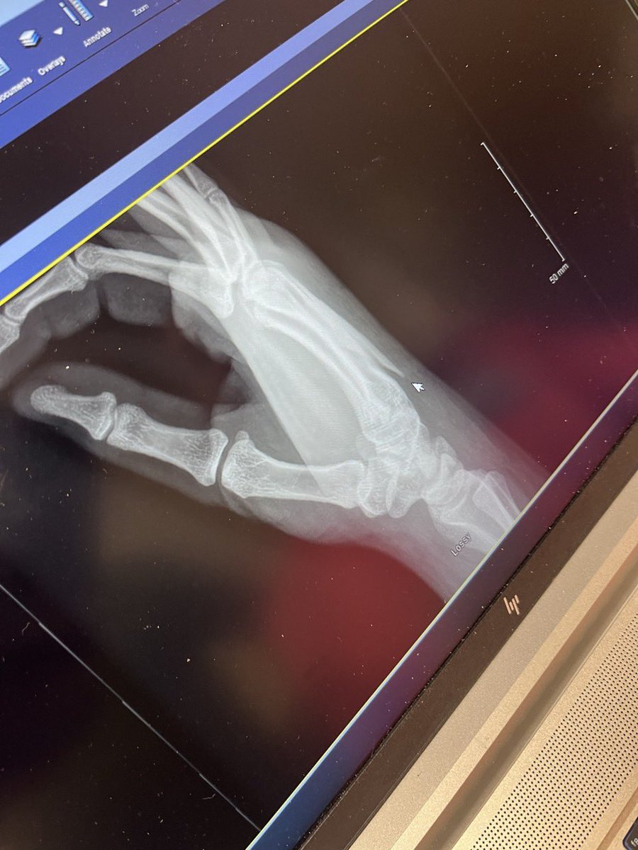 <a href="/JaydenMoehle/">Jayden</a> <a href="/USAWrestling/">USA Wrestling</a> 16U All American… ONE HANDED!!!