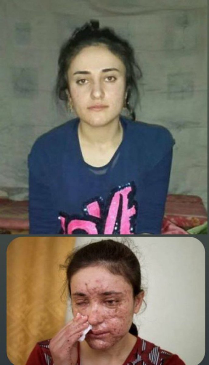 AzatAlsalim's tweet photo. Lamiya, is a Yezidi girl, who was kidnapped and sexually abused by lSlS, says:“lSlS considers Yezidis Kaffirs, kill and enslave them.“

Lamiya was able to escape after many failed attempts.

She escaped with 2 Yezidi girls,but landmine bombed on them.
She survived both other died https://t.co/elijGPqqvL