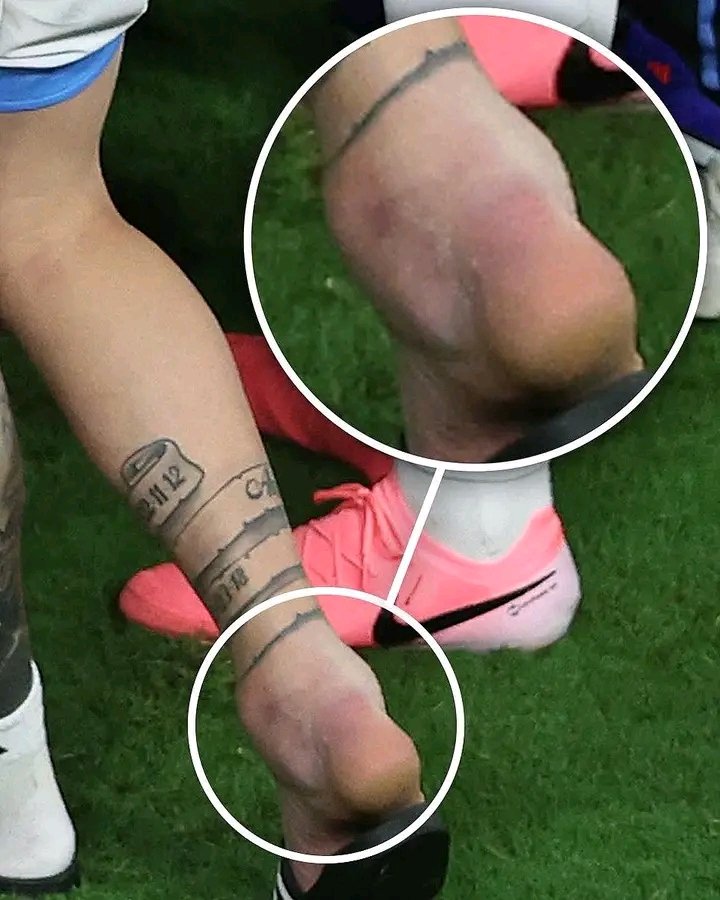 Imtamim_'s tweet photo. Leo Messi’s ankle. 😨 https://t.co/JgbWFh02Wa