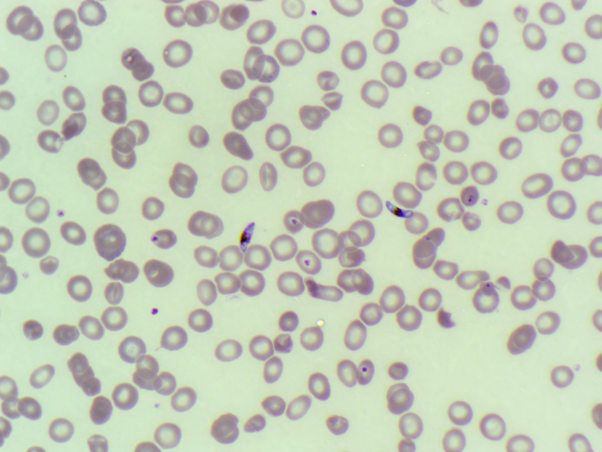 BloodScientist's tweet photo. #MorphologyMonday

"Hey Anas," said my colleague as I walked into the lab for my late shift. "Check out this interesting film we got earlier in the day."

What can you see on the film? 🤔

#OnlyCells #RedCells #Parasites https://t.co/if0tQ1cbvd