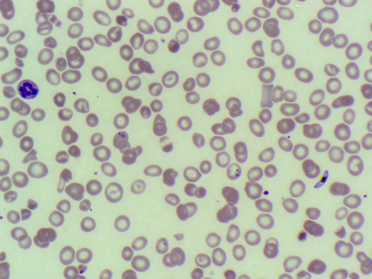 BloodScientist's tweet photo. #MorphologyMonday

"Hey Anas," said my colleague as I walked into the lab for my late shift. "Check out this interesting film we got earlier in the day."

What can you see on the film? 🤔

#OnlyCells #RedCells #Parasites https://t.co/if0tQ1cbvd