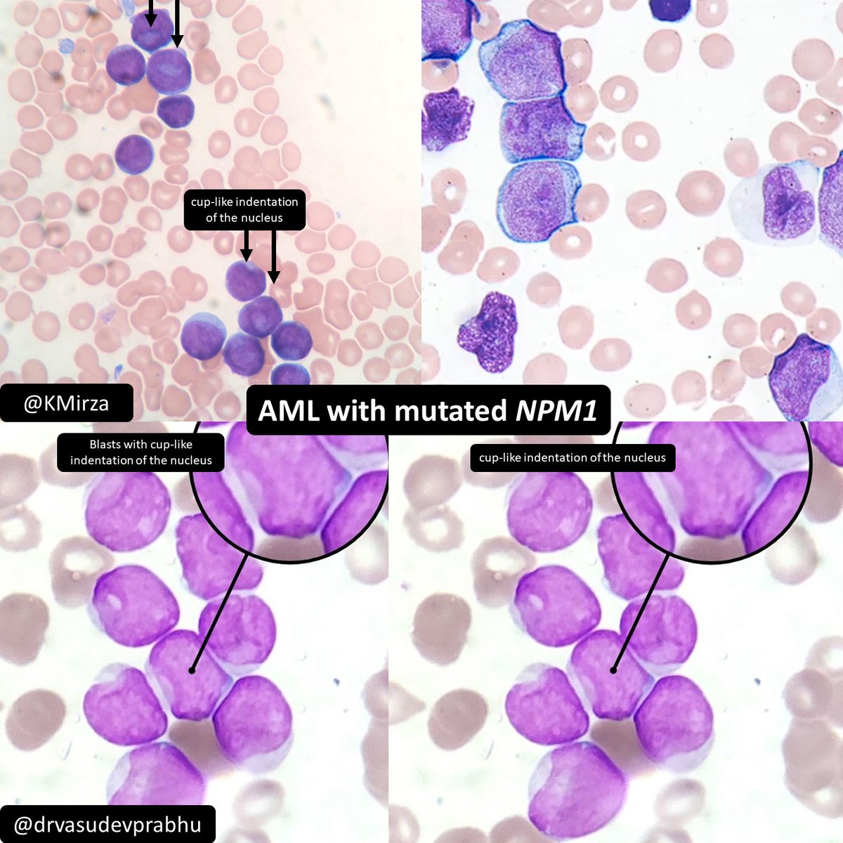 DrCycloPath's tweet photo. ✅Cup-like indentation is seen in AML with NPM1 mutation, also associated with FLT3 abnormalities
⚠️Cup-like invagination in myeloid blasts is not entirely specific for NPM1 or FLT3 abnormalities, but its presence can help triage ancillary studies
AML morphologies & cytogenetics ↘️↘️↘️
https://t.co/COmdoqqKmj
#HemePath #PathTwitter #pathology