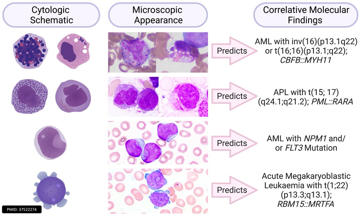 ✅Cup-like indentation is seen in AML with NPM1 mutation, also associated with FLT3 abnormalities
⚠️Cup-like invagination in myeloid blasts is not entirely specific for NPM1 or FLT3 abnormalities, but its presence can help triage ancillary studies
AML morphologies &amp; cytogenetics
