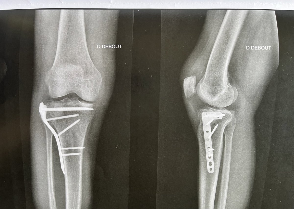 cubachedegouges's tweet image. T’as vu comment j’suis belle ? #radio #ortho #genou