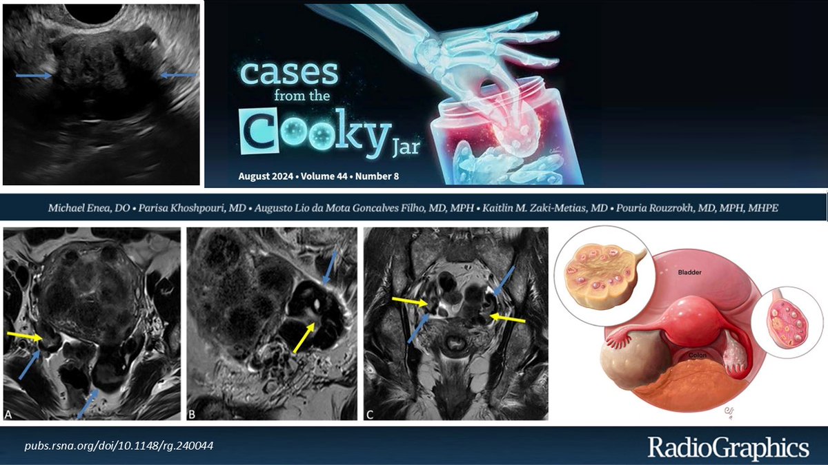 Cases From the Cooky Jar (@casescookyjar) on Twitter photo 58-year-old woman with bloating and pelvic pain. Diagnosis❓
Answer: 🔗pubs.rsna.org/doi/10.1148/rg…
#CookyBites #173 and we will RT the best cases!
<a href="/cookyscan1/">Cooky Menias</a>
<a href="/RadioGraphics/">RadioGraphics</a>
#RGphx 58-year-old woman with bloating and pelvic pain. Diagnosis❓
Answer: 🔗pubs.rsna.org/doi/10.1148/rg…
#CookyBites #173 and we will RT the best cases!
<a href="/cookyscan1/">Cooky Menias</a>
<a href="/RadioGraphics/">RadioGraphics</a>
#RGphx