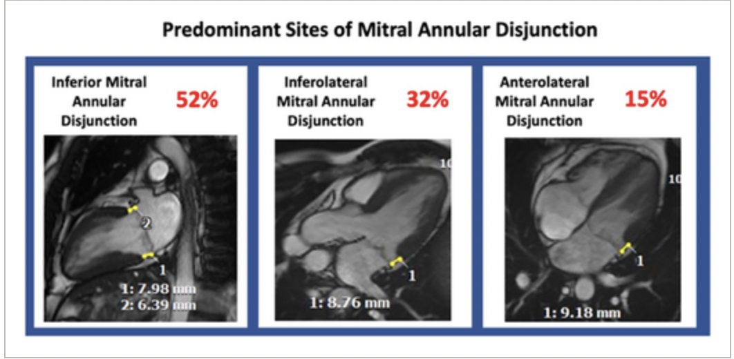 Luis Lopes (@luisrlopes77) on Twitter photo Mitral Annulus Disjunction: Magnetic Resonance Phenotype and Clinical Outcomes. Our contribution to an ongoing debate, #CMR perspective <a href="/JccmoonMoon/">James moon</a> <a href="/LambiasePier/">Pier Lambiase</a> <a href="/dianadecampos1/">Diana de Campos</a> <a href="/AnaRitaMoura5/">Ana Rita Moura</a> <a href="/HunainShiwani/">Hunain Shiwani</a> <a href="/drgeorgejoy/">George Joy</a> <a href="/KSavvatis/">Konstantinos Savvatis</a> onlinelibrary.wiley.com/doi/full/10.10… Mitral Annulus Disjunction: Magnetic Resonance Phenotype and Clinical Outcomes. Our contribution to an ongoing debate, #CMR perspective <a href="/JccmoonMoon/">James moon</a> <a href="/LambiasePier/">Pier Lambiase</a> <a href="/dianadecampos1/">Diana de Campos</a> <a href="/AnaRitaMoura5/">Ana Rita Moura</a> <a href="/HunainShiwani/">Hunain Shiwani</a> <a href="/drgeorgejoy/">George Joy</a> <a href="/KSavvatis/">Konstantinos Savvatis</a> onlinelibrary.wiley.com/doi/full/10.10…