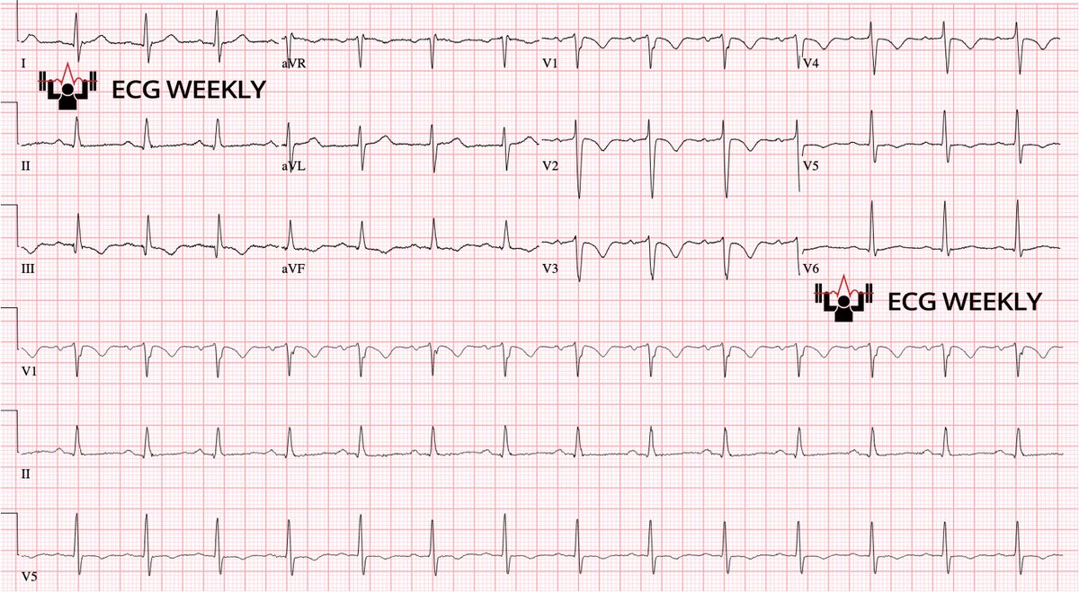 A 67 -year-old man presents to a busy emergency department with acute chest pain and shortness of breath. The following ECG is obtained, but he leaves without being seen because of the long wait time ... rebrand.ly/2hoq68f