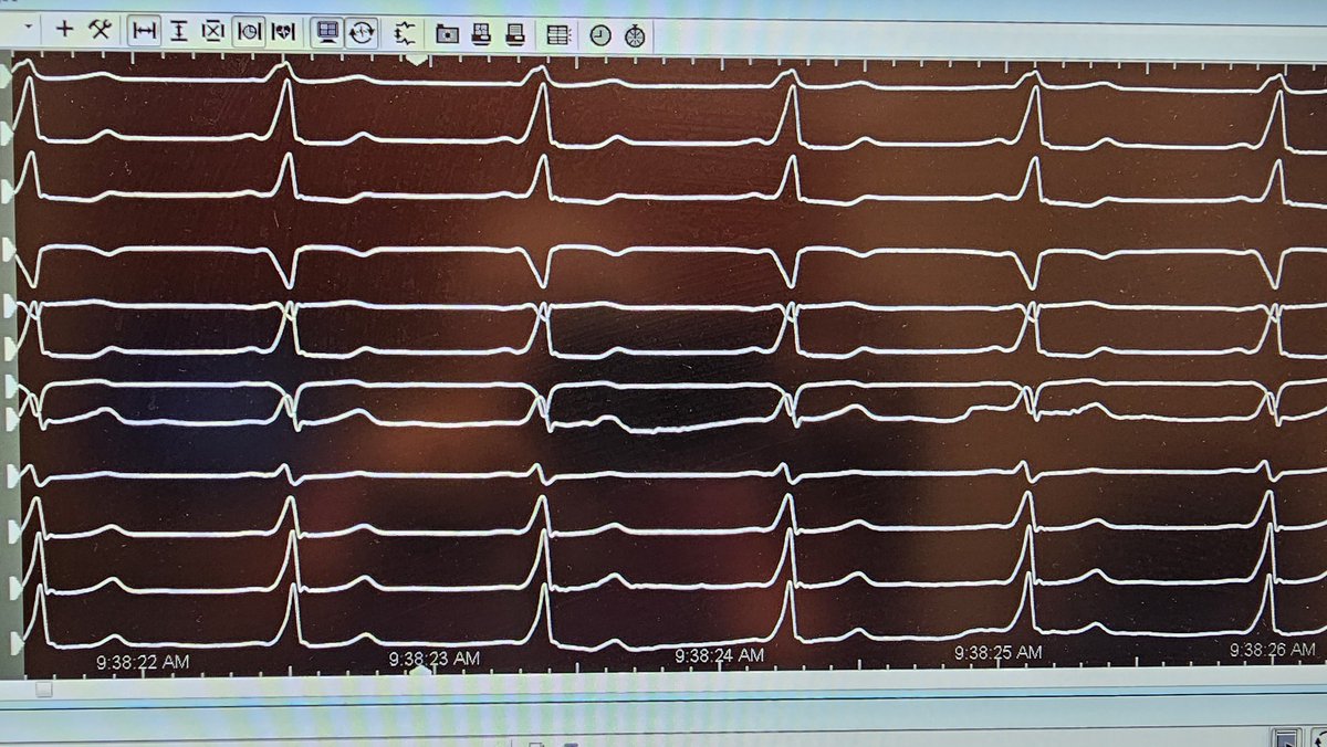 Moti_Haim's tweet photo. A case of ParaHisian accessory pathway ablated from the aorirc non coronary cusp. -30 Ms earlier than delta very close to His .Attempts to ablate with RF and CRYO bothe from femoral approach and IJ failed. Finally ablation from NCC was successful . https://t.co/HTlSUicWHt