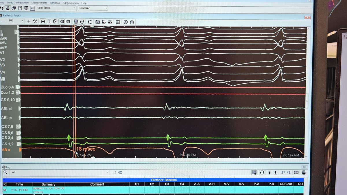 Moti_Haim's tweet photo. A case of ParaHisian accessory pathway ablated from the aorirc non coronary cusp. -30 Ms earlier than delta very close to His .Attempts to ablate with RF and CRYO bothe from femoral approach and IJ failed. Finally ablation from NCC was successful . https://t.co/HTlSUicWHt