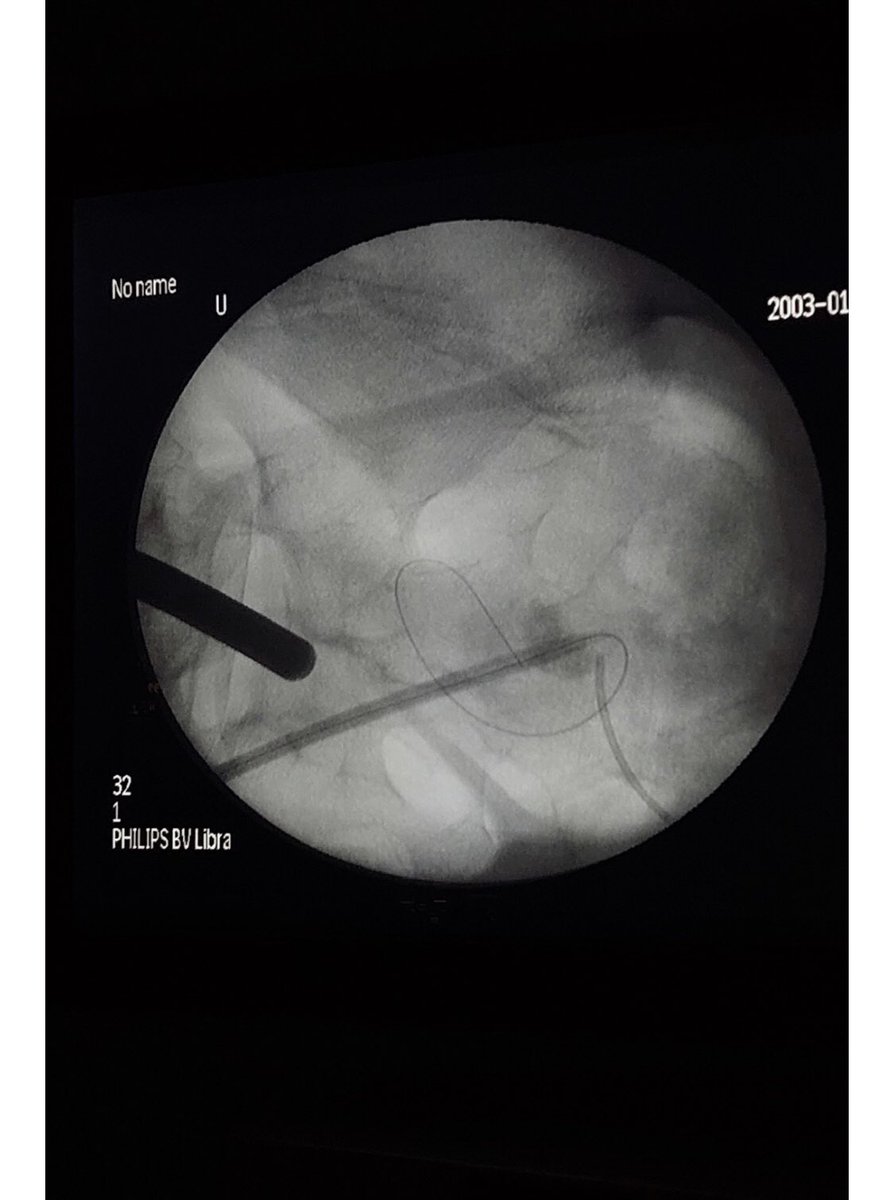 eden2029's tweet photo. Lap assisted PCNL !! Excellent experience https://t.co/i5HUwHyyF2