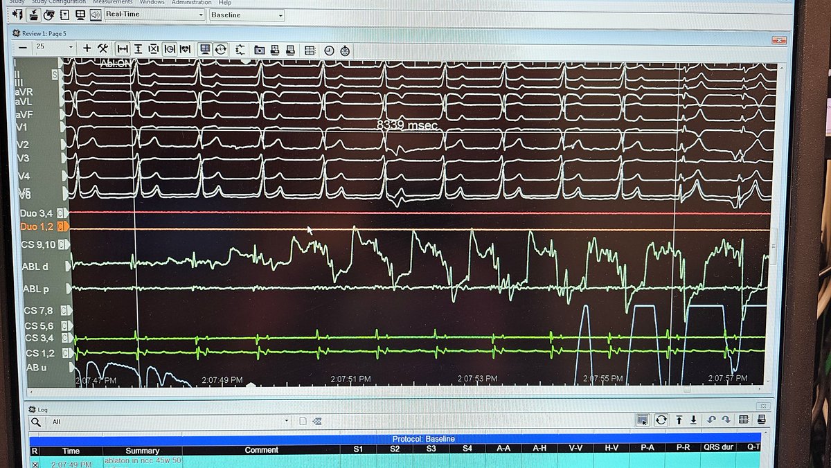 Moti_Haim's tweet photo. After ablation a clear HIS potential is seen on the ablation catheter. Final ECG shown. https://t.co/9LE2lplHiq