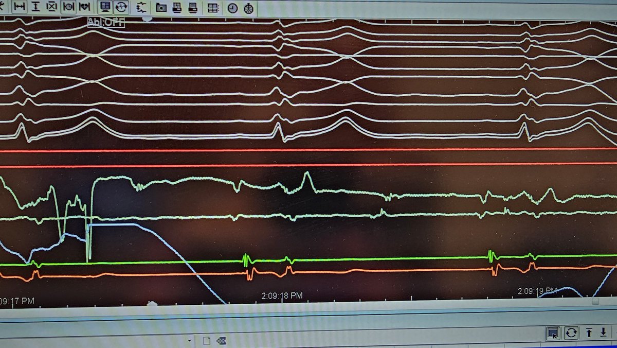 Moti_Haim's tweet photo. After ablation a clear HIS potential is seen on the ablation catheter. Final ECG shown. https://t.co/9LE2lplHiq