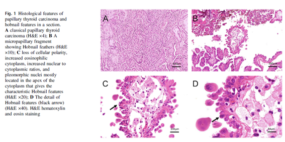 🦋Analyzing the correlation between low proportion of hobnail features in papillary thyroid carcinoma and clinical aggressiveness risk

▶️* El #CPT con una proporción baja de células clavo (<30%) se asocia con la aparición de mts linfáticas

link.springer.com/article/10.100…
@SeenTiro