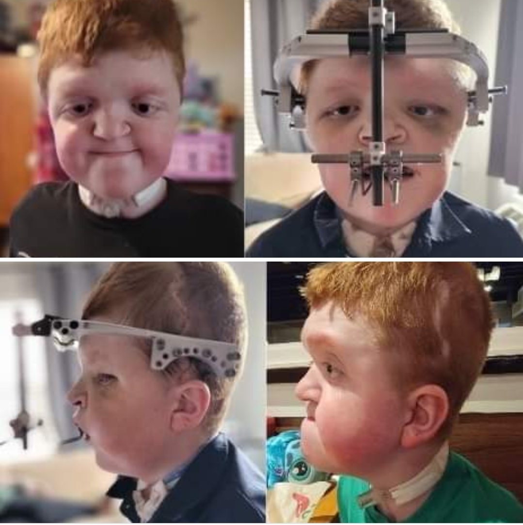 Jacoker936's tweet photo. We are finally home. He's so incredibly strong!
Here's before and 10 days after surgery. Follow along his journey here
https://t.co/stMGJKj9Tn
#apert #midfacesurgery #lefort #myhero @zerohero936 https://t.co/5smBIYqimv