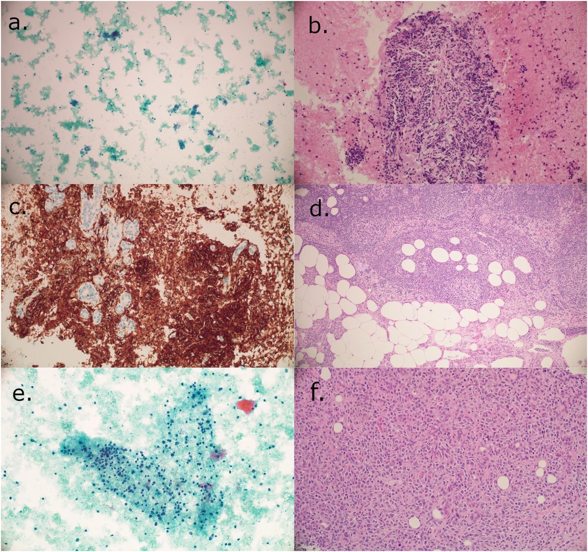 CancerCytopath's tweet photo. Want to know how the AUS @MilanSystem category works in the real world? Read the latest by @IvanaKholova et al: ROMs, cytologic and histologic correlation, and timelines of management

Available #OpenAccess 👇 https://t.co/jTP5z0TGFr

#CytoPath https://t.co/nk4PuLSzs8