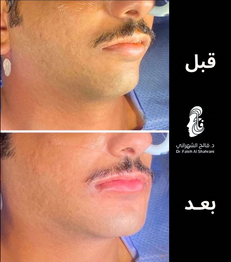 Fa_omf's tweet photo. #حالة_اليوم_من_العيادة 
▪️مراجعي الغالي بعد عملية جراحة الفكين 👌 https://t.co/RqKcLoIAPI