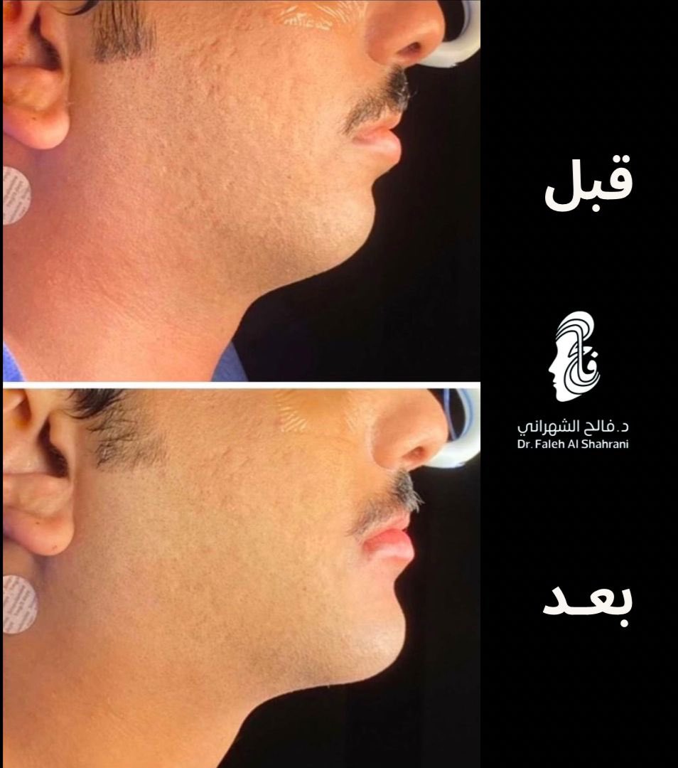 Fa_omf's tweet photo. #حالة_اليوم_من_العيادة 
▪️مراجعي الغالي بعد عملية جراحة الفكين 👌 https://t.co/RqKcLoIAPI