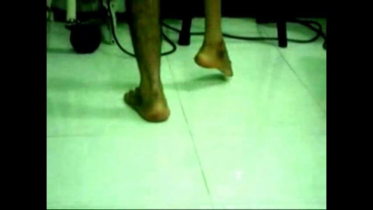 Joint_Success's tweet photo. Describe the gait pattern in this video.
Why do patients with polio walk in this way?

https://t.co/zoXpPjxRz0 https://t.co/PIJtEwhJeH