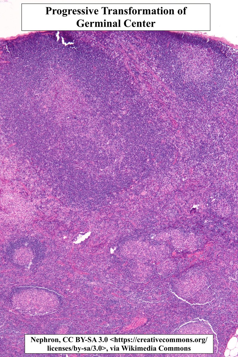 Progressive Transformation of Germinal Centers (PTGC)

•Characterized by chronic lymphadenopathy w wide age distribution
•🔬Expansile follicles w mantle zone expanding into+disrupting germinal center 
•Benign but may be ass w/ NLP Hodgkin's Lymphoma

#pathagonia  #heme #pathx