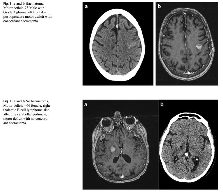 KingsNeuro's tweet photo. Publication Alert!
"To scan or not to scan": A retrospective cohort study analysing the efficacy of routine post-operative CT after brain biopsy in @ActaNeuro .

Read more: https://t.co/gsRMfjh17L
👉@aelhagSN @lavrador_jose https://t.co/0aoKS75WND