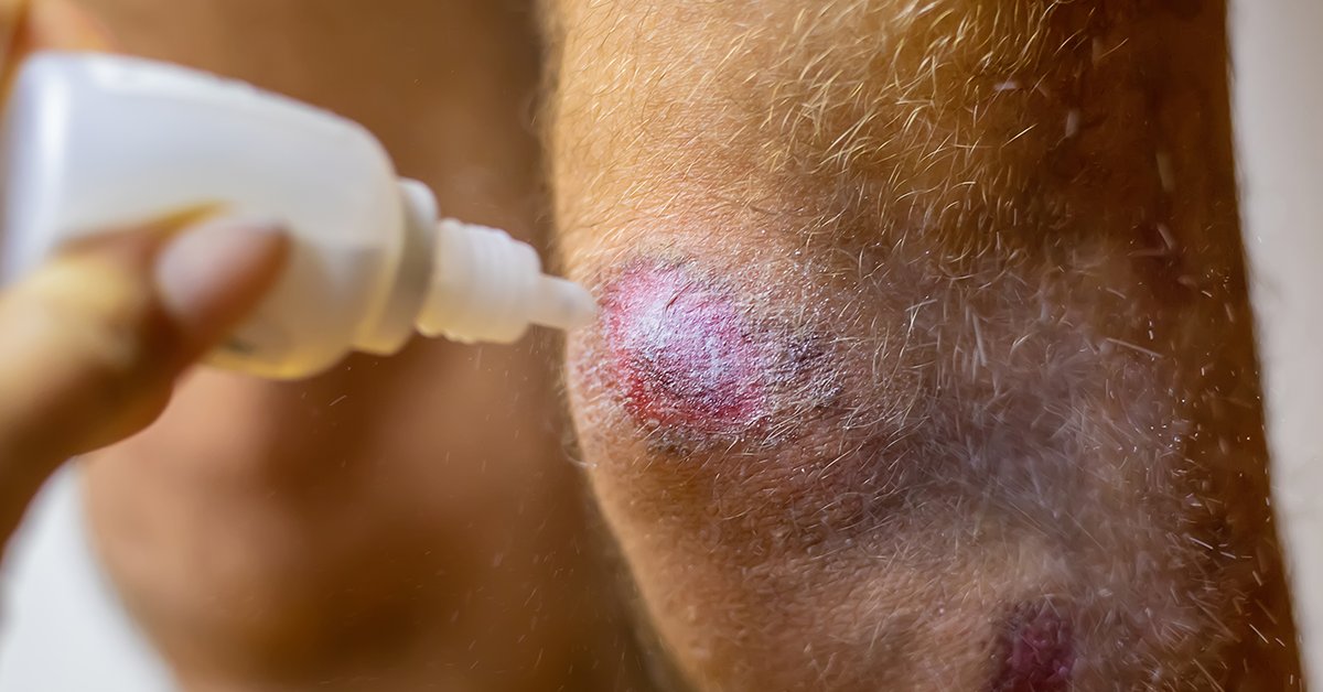 ReachMD (@reachmd) on Twitter photo Do you struggle with getting patients to stick to their prescribed topical psoriasis medications? Tune in to hear <a href="/RajMDPhD/">Raj Chovatiya, MD PhD</a> and <a href="/DrSteveFeldman/">Dr.Steven R. Feldman</a> discuss strategies for enhancing patient adherence in #psoriasis care: ow.ly/gHSw50SBInq
#dermatology Do you struggle with getting patients to stick to their prescribed topical psoriasis medications? Tune in to hear <a href="/RajMDPhD/">Raj Chovatiya, MD PhD</a> and <a href="/DrSteveFeldman/">Dr.Steven R. Feldman</a> discuss strategies for enhancing patient adherence in #psoriasis care: ow.ly/gHSw50SBInq
#dermatology