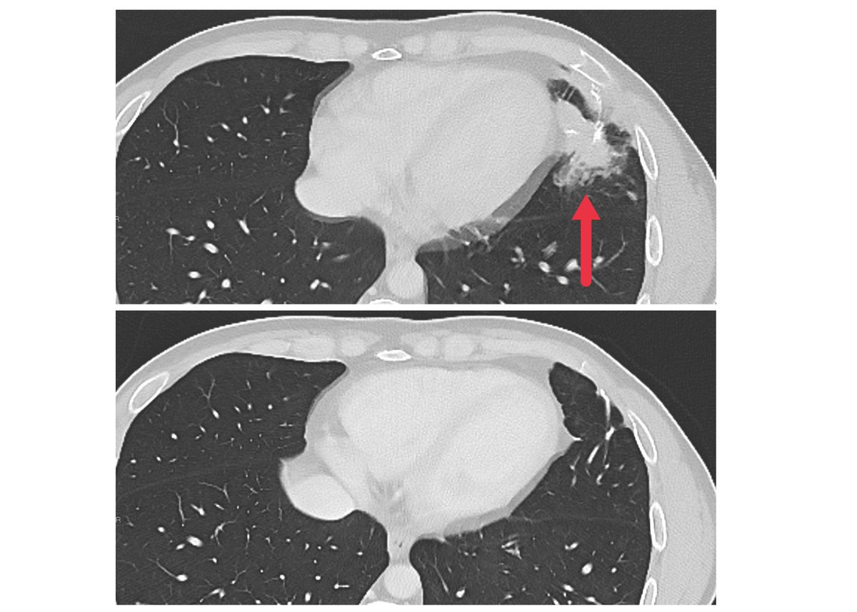 NCIDirector's tweet photo. Hot off the press from Dr. Steven Rosenberg and team: Early findings from a small #ClinicalTrial provide evidence that a new cellular immunotherapy approach may be effective in treating metastatic solid tumors. https://t.co/W660KOYfuh @NCIResearchCtr #Immunotherapy https://t.co/IIKMCwaFOM