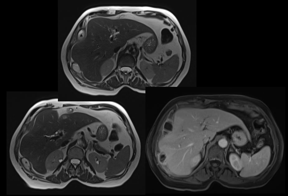 SAR DFP Benign Biliary Pathology (@sarbiliarydfp) on Twitter photo Challenge yourself with another biliary case:
Case courtesy of Malak Itani MD <a href="/ItaniMalak/">Malak Itani</a> from Mallinckrodt <a href="/MIRimaging/">WashUMedMIR</a>
78 y.o. woman with abdominal pain 6 months after cholecystectomy Challenge yourself with another biliary case:
Case courtesy of Malak Itani MD <a href="/ItaniMalak/">Malak Itani</a> from Mallinckrodt <a href="/MIRimaging/">WashUMedMIR</a>
78 y.o. woman with abdominal pain 6 months after cholecystectomy