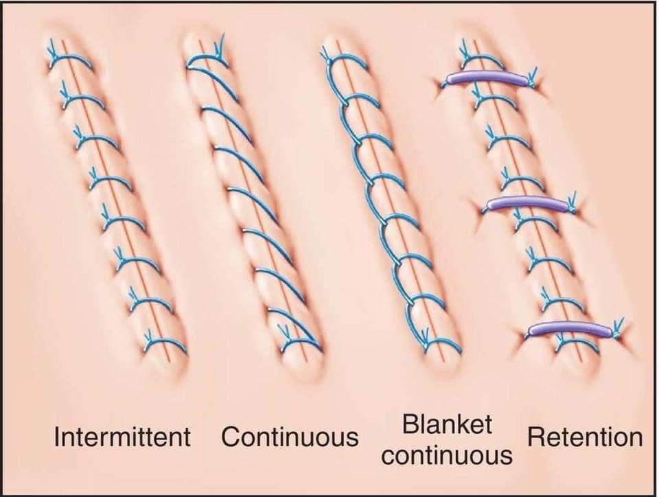 Doctors__squad's tweet photo. Types of suture ✔️ https://t.co/clZy1CQ52u