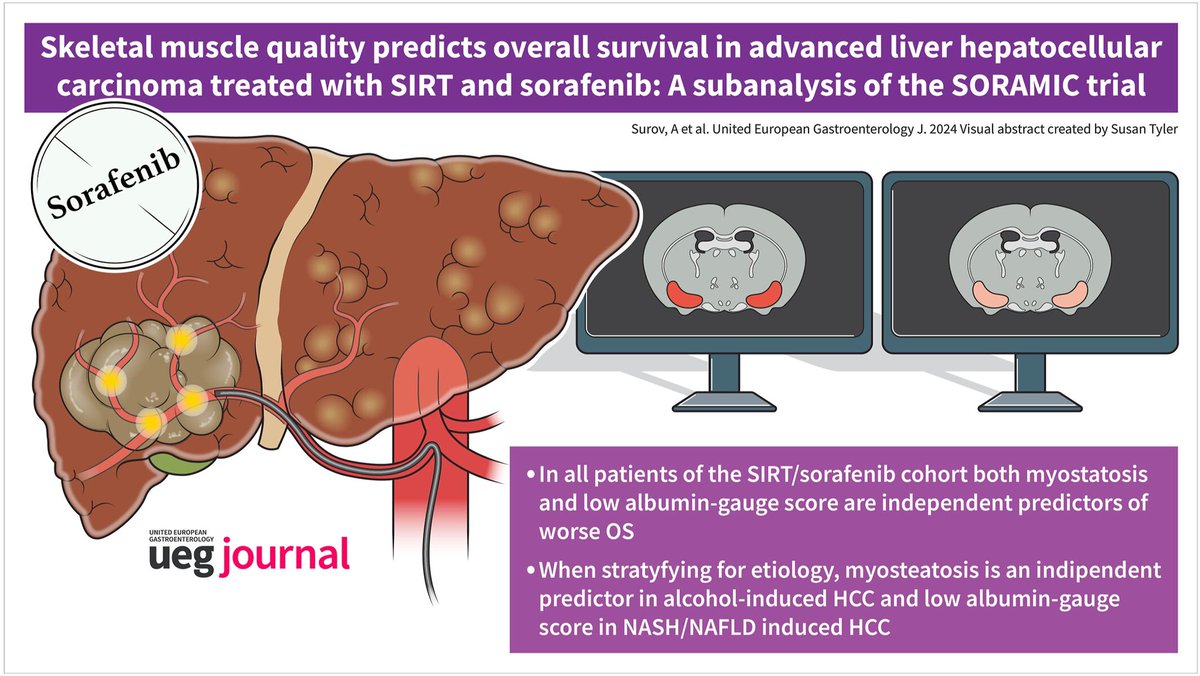 - SIRT/Sorafenib, Myosteatosis predicts worse OS
- Alcohol-induced HCC, Myosteatosis predicts worse OS
- Viral-induced HCC Muscle quality doesn't predict OS
- NASH/NAFLD HCC Low albumin-gauge score predicts worse OS in SIRT/Sorafenib cohort

doi.org/10.1002/ueg2.1…