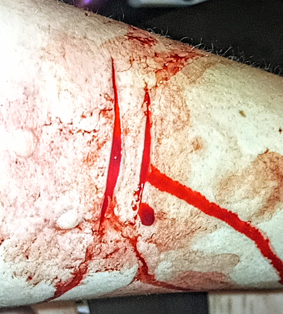lus_corpse's tweet photo. Arm cuts :> #sh #selfharm #shtwt #cuts #armcuts #blood #bloody #bloodkink #bloodyarm #bloodyhand #bloodythigh #tattoo #stickandpoke #styro #hitthestyro https://t.co/zRXeZSbNLm