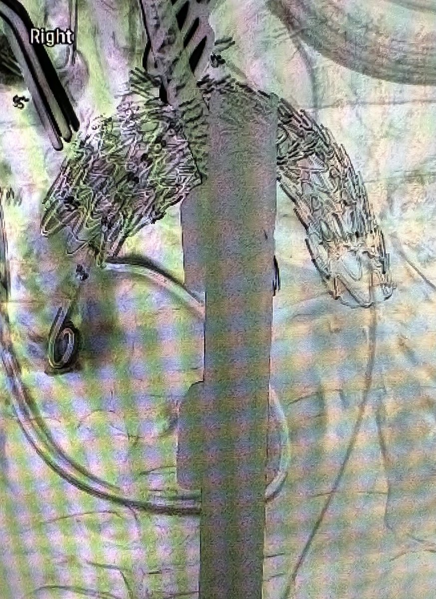 …Hybrid Total Arch in Re-Do - several years post Type A dissection - NO bypass, NO circ arrest &gt;&gt; home on postop day 5… 
..Endo Aortic surgery is !!CRUCIAL!! Minimally Invasive Cardiac surgery skill…❤️❤️❤️💪💪💪