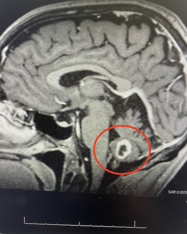 Today I'm sharing a very personal story. I hope that by sharing it, I might help someone else in the world.

In February 2023, I underwent emergency brain surgery to remove what — at the time — my doctors thought could be a stage 4 glioblastoma tumor: terminal brain cancer.  

I