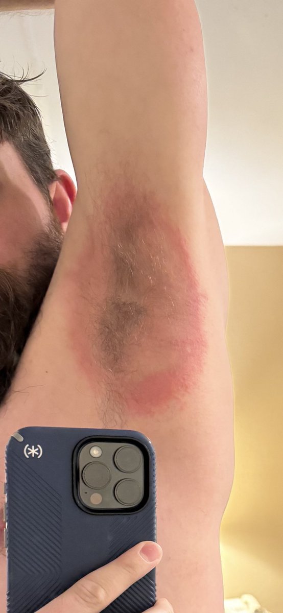 nickbellard's tweet photo. Hey @everymanjack - first time customer here! Last week I used your deodorant literally ONCE and this happened. I thought this company was the healthy, natural alternative to the big brands. Definitely neither of those things. (1/2) https://t.co/KgAQjeY7Wo