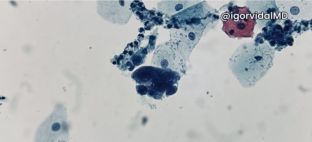 igorvidalMD's tweet photo. What is the viral infection and the three classic findings?
#pathparlor #cytology #cytopath #cytopathology #pathtwitter #medtwitter #MedEd #uabcyto @UABPathology https://t.co/pKt0EKitRX