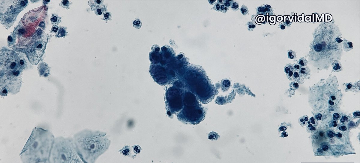 igorvidalMD's tweet photo. What is the viral infection and the three classic findings?
#pathparlor #cytology #cytopath #cytopathology #pathtwitter #medtwitter #MedEd #uabcyto @UABPathology https://t.co/pKt0EKitRX