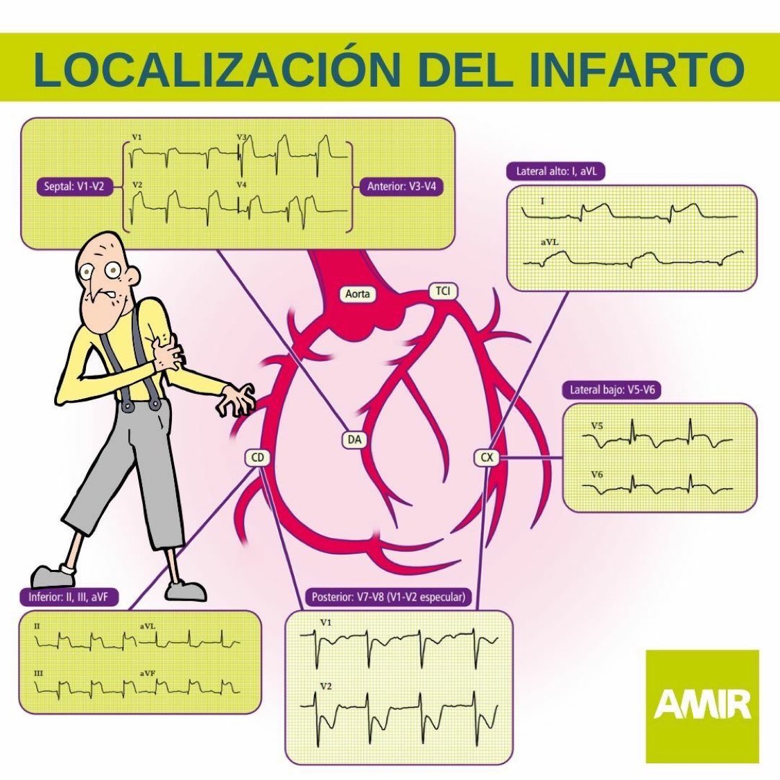 Localización del infarto en EKG:
