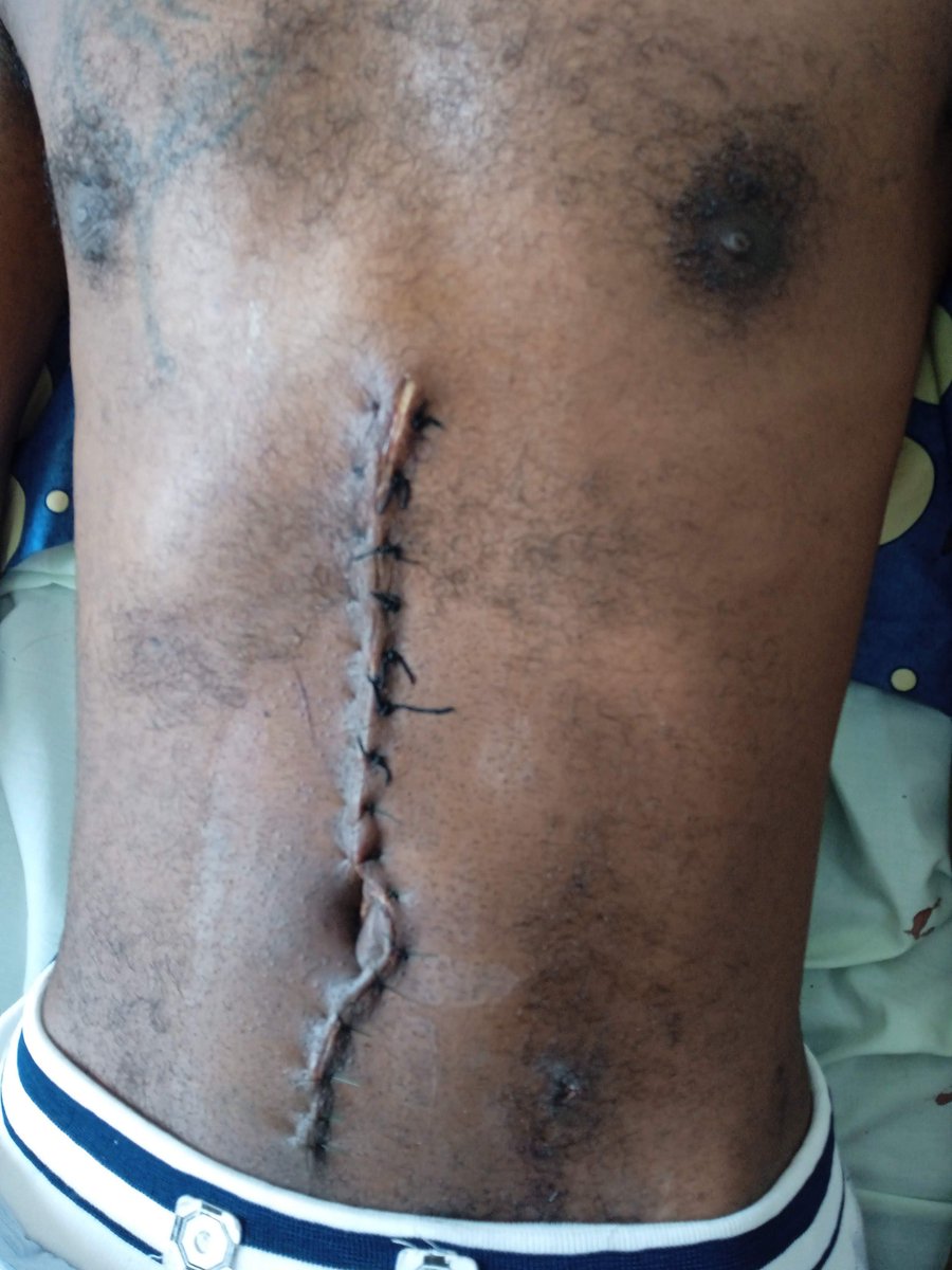 QuissuaDavid's tweet photo. Num dia como hoje eu estava a receber alto no Hospital Geral do Camama.

Quase perdi a vida num acidente de moto.

Tive e uma segunda chance e não me canso de aproveita-la !!! https://t.co/nT3jjW1vLL