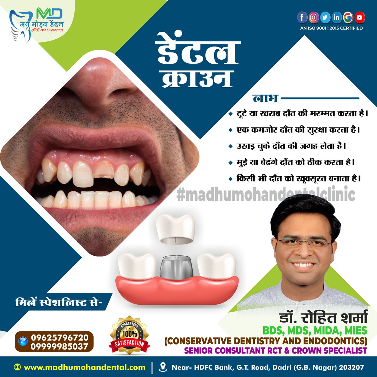 madhu_m_dental's tweet photo. Restore your smile with our durable dental crowns. Achieve natural-looking, long-lasting results that enhance both function and beauty.
#DentalCrown #SmileRestoration #NaturalLook #LongLasting #ConfidentSmile #OralHealth #brighterteeth #GumCare #KatrinaKaif #GreaterNoida #INDvSL https://t.co/9FyIMMAwk3