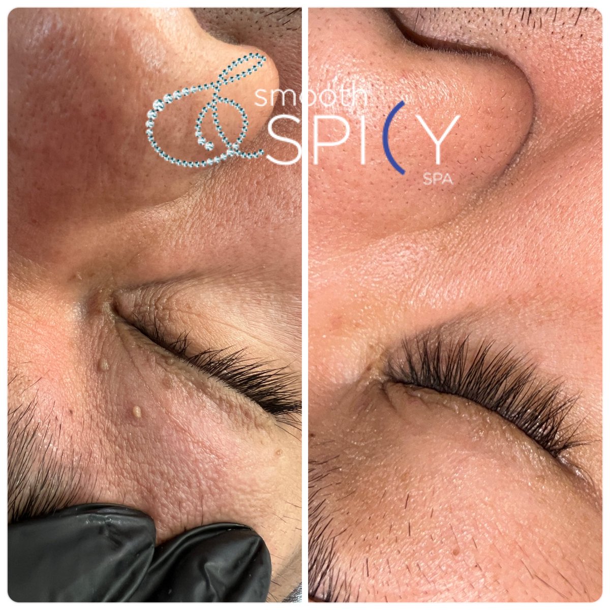 SSpicyspa's tweet photo. Smooth away skin tags: quick, painless, and effective! #smoothandspicyspa™️ https://t.co/CeeahdV46C