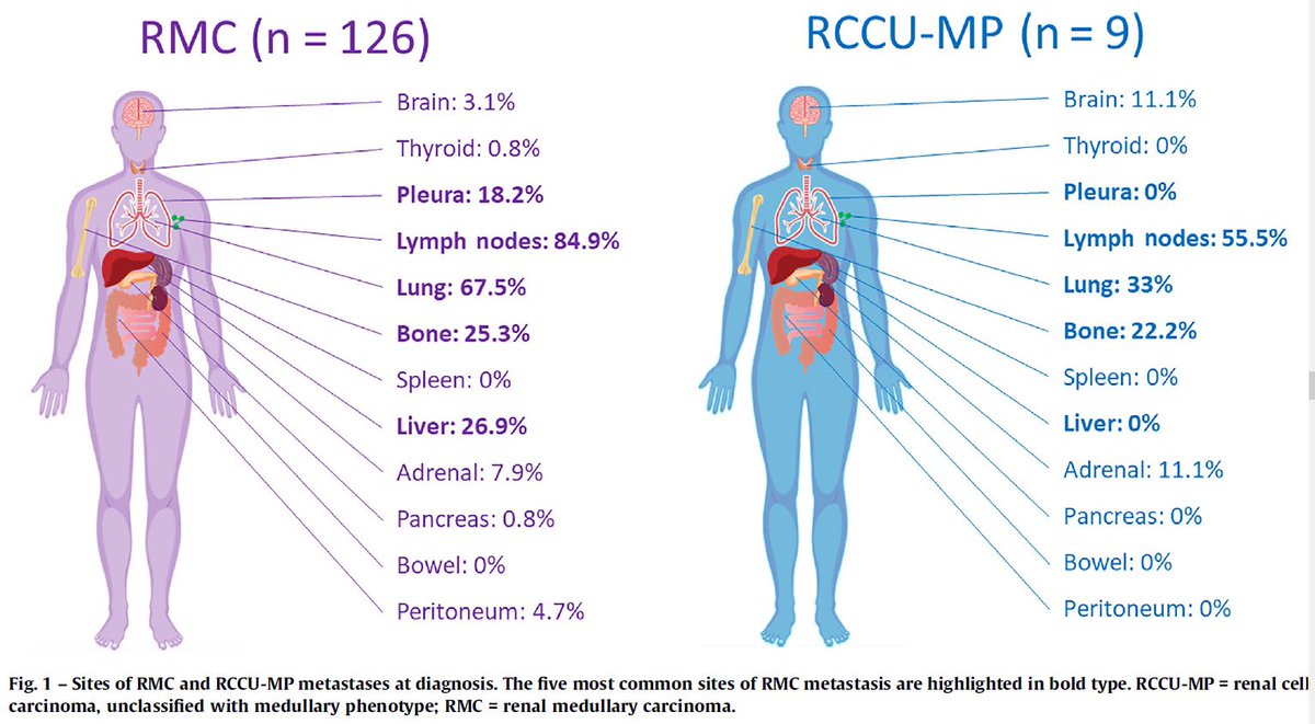 Pavlos Msaouel (@pavlosmsaouel) on Twitter photo <a href="/KimrynRathmell/">Kimryn Rathmell</a> <a href="/NCIDirector/">Dr. Kimryn Rathmell</a> <a href="/montypal/">Sumanta K. Pal, MD, FASCO</a> <a href="/kaydaustin/">Katie Coleman</a> <a href="/salvolarosa/">Salvatore La Rosa</a> <a href="/lalaniMD/">Aly-Khan Lalani</a> <a href="/WallisCJD/">Christopher Wallis (he/him/his)</a> <a href="/FaltasLab/">Dr. Bishoy M. Faltas</a> <a href="/TiansterZhang/">Tian Zhang, MD, MHS</a> <a href="/rovingatuscap/">Samson W. Fine, MD</a> <a href="/d_shapiro1/">Daniel Shapiro</a> <a href="/OAlhalabiMD/">Omar Alhalabi, MD</a> <a href="/JadChahoud/">jc</a> <a href="/shilpaonc/">Shilpa Gupta</a> <a href="/shilpa_surasi/">Shilpa Surasi</a> <a href="/GabrielMalouf/">Gabriel Malouf</a> <a href="/SGoswamiMDPhD/">Sangeeta Goswami, MD,PhD</a> <a href="/CCoarfa/">Cristian Coarfa</a> <a href="/QingZhangLab/">Qing Zhang</a> <a href="/MikeSerzanMD/">Michael Serzan, MD</a> 4/5 We found that retroperitoneal lymph nodes are by far the most common metastasis site, while brain mets appear relatively rare. RMC in the absence of sickle hemoglobinopathy (RCCU-MP) is very rare (~7% of cases) and may be less aggressive than typical #RenalMedullaryCarcinoma. <a href="/KimrynRathmell/">Kimryn Rathmell</a> <a href="/NCIDirector/">Dr. Kimryn Rathmell</a> <a href="/montypal/">Sumanta K. Pal, MD, FASCO</a> <a href="/kaydaustin/">Katie Coleman</a> <a href="/salvolarosa/">Salvatore La Rosa</a> <a href="/lalaniMD/">Aly-Khan Lalani</a> <a href="/WallisCJD/">Christopher Wallis (he/him/his)</a> <a href="/FaltasLab/">Dr. Bishoy M. Faltas</a> <a href="/TiansterZhang/">Tian Zhang, MD, MHS</a> <a href="/rovingatuscap/">Samson W. Fine, MD</a> <a href="/d_shapiro1/">Daniel Shapiro</a> <a href="/OAlhalabiMD/">Omar Alhalabi, MD</a> <a href="/JadChahoud/">jc</a> <a href="/shilpaonc/">Shilpa Gupta</a> <a href="/shilpa_surasi/">Shilpa Surasi</a> <a href="/GabrielMalouf/">Gabriel Malouf</a> <a href="/SGoswamiMDPhD/">Sangeeta Goswami, MD,PhD</a> <a href="/CCoarfa/">Cristian Coarfa</a> <a href="/QingZhangLab/">Qing Zhang</a> <a href="/MikeSerzanMD/">Michael Serzan, MD</a> 4/5 We found that retroperitoneal lymph nodes are by far the most common metastasis site, while brain mets appear relatively rare. RMC in the absence of sickle hemoglobinopathy (RCCU-MP) is very rare (~7% of cases) and may be less aggressive than typical #RenalMedullaryCarcinoma.