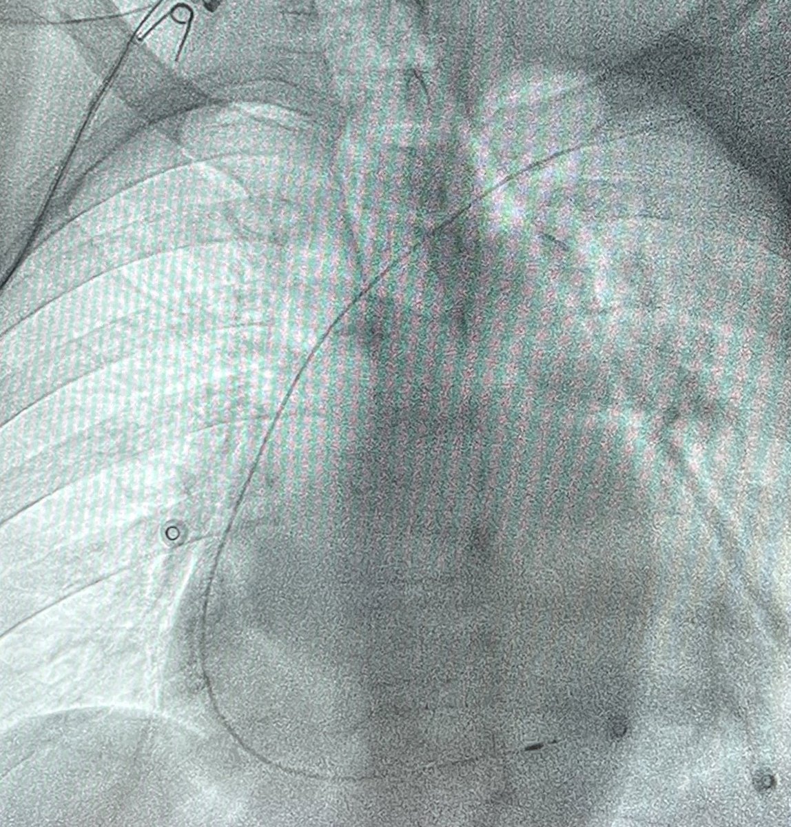 EPWaveDoc's tweet photo. #LBBAP shortening QRS in patient with RBBB and bradyarrhythmia due to probable cardiac amyloidosis. Procedure with #fellowsfirst Dr Alpha Barry @CHUM972 #Martinique https://t.co/lX6j0VD3iL