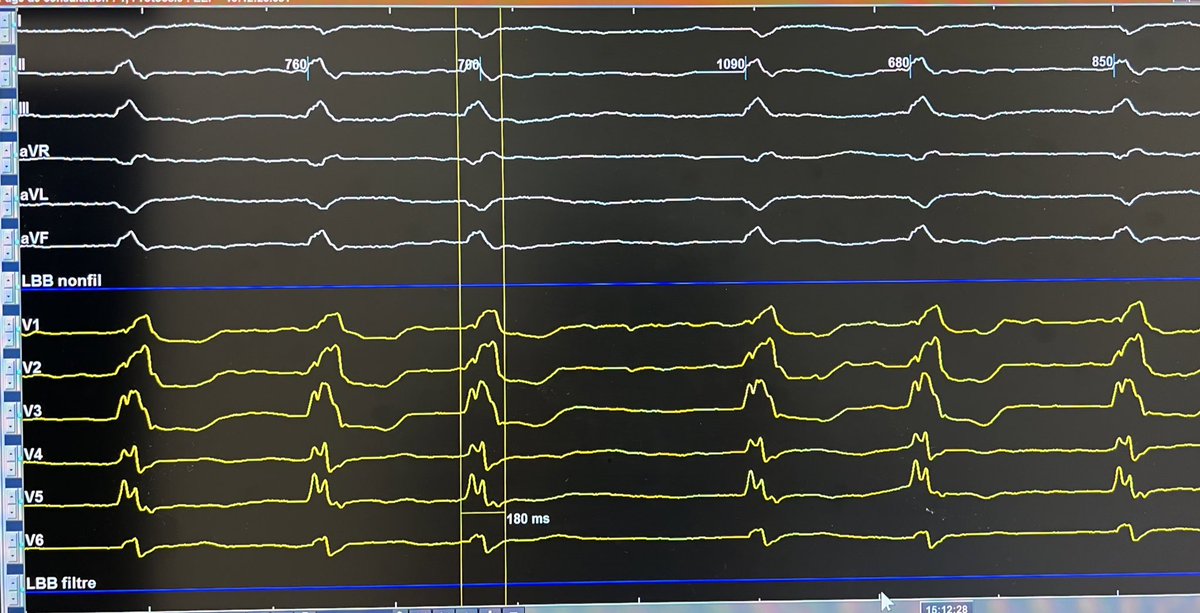 EPWaveDoc's tweet photo. #LBBAP shortening QRS in patient with RBBB and bradyarrhythmia due to probable cardiac amyloidosis. Procedure with #fellowsfirst Dr Alpha Barry @CHUM972 #Martinique https://t.co/lX6j0VD3iL