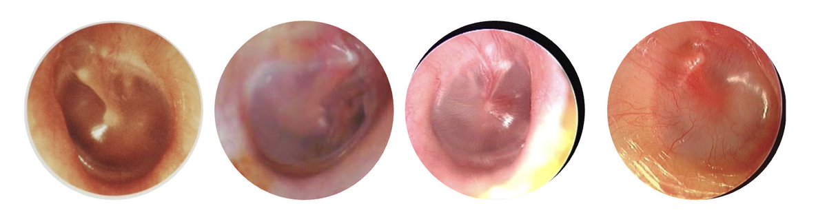 GPswampwarrior's tweet image. Want to know why GPs are worried about pharmacists managing ears? One of these needs antibiotics, one is cancer. Confident you could tell which is which? Can the pharmacist? This is why we think our trainees need 11 years to tell these things apart. Over confidence is dangerous