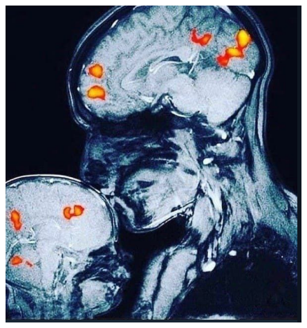 Cd615cgMorpheus's tweet photo. Risonanza magnetica - il legame insito tra madre e figlio a livello cerebrale. 
Ossitocina : amore e affetto
Vasopressina : legame indissolubile
Dopamina - Serotonina: regolatori dell'umore

Quando si compra un neonato il legame è disallineato, un legame illeggibile.
#BrainMind https://t.co/QkgO7axzsH